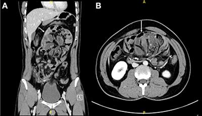 Abdominal cocoon syndrome (idiopathic sclerosing encapsulating peritonitis): An extremely rare cause of small bowel obstruction—Two case reports and a review of literature